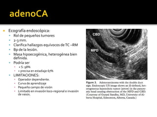  Ecografía endoscópica:
 Rol de pequeños tumores
 2-3 mm.
 Clarifica hallazgos equívocos deTC –RM
 Bp de la lesión.
 Masa hipoecogénica, heterogénea bien
definida.
 Podría ser
▪ + S: 98%
▪ + precisa en estadiaje 67%
 LIMITACIONES:
▪ Operador dependiente.
▪ Curva de aprendizaje
▪ Pequeño campo de visión
▪ Limitado en invasión loco-regional e invasión
de vasos.
 