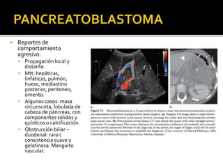  Reportes de
comportamiento
agresivo:
 Propagación local y
distante.
 Mtt: hepáticas,
linfáticas, pulmón,
hueso, mediastino
posterior, peritoneo,
omento.
 Algunos casos: masa
circunscrita, lobulada de
cabeza de páncreas, con
componentes sólidos y
quísticos o calcificación.
 Obstrucción biliar –
duodenal: raro (
consistencia suave y
gelatinosa. Manguito
vascular.
 