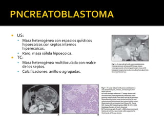  US:
 Masa heterogénea con espacios quísticos
hipoecoicos con septos internos
hiperecoicos.
 Raro: masa sólida hipoecoica.
 TC:
 Masa heterogénea multiloculada con realce
de los septos.
 Calcificaciones: anillo o agrupadas.
 