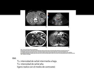 RM:
T1: intensidad de señal intermedia a baja.
T2: intensidad de señal alta
ligero realce con el medio de contraste)
 
