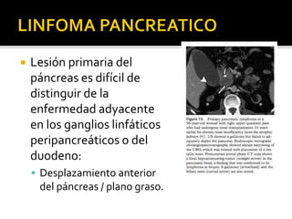  Lesión primaria del
páncreas es difícil de
distinguir de la
enfermedad adyacente
en los ganglios linfáticos
peripancreáticos o del
duodeno:
 Desplazamiento anterior
del páncreas / plano graso.
 