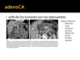 10% de los tumores son iso-atenuantes:
Signos indirectos:
Efecto de
masa.
Contorno
convexo
Obstrución
ductal
Invasión
vascular
 