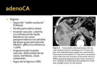  Signos:
 Signo del “ doble conducto”
(Cabeza)
 Atrofia pancreática distal.
 Invasión vascular: cubierta
circunferencial de tejido
blando en los vasos
peripancreáticos con pérdida
del plano graso perivascular.
S84% E: 98% (circunferencia
> 50%)
 Sugerencia de invasión
vascular: deformidad de los
vasos, trombosis, vasos
colaterales.
 Signo de la lágrima:VMS.
 