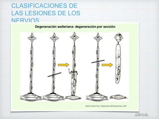 CLASIFICACIONES DE
LAS LESIONES DE LOS
NERVIOS
Dr. Vejarano A., Willy
Ortopedista y Traumatologo
 