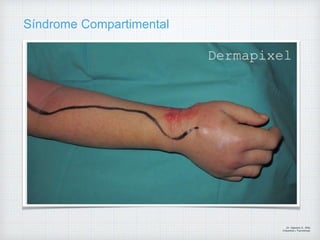 Síndrome Compartimental
Dr. Vejarano A., Willy
Ortopedista y Traumatologo
 