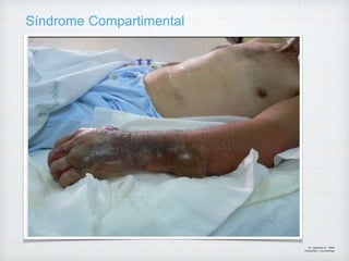 Síndrome Compartimental
Dr. Vejarano A., Willy
Ortopedista y Traumatologo
 