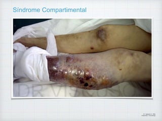 Síndrome Compartimental
Dr. Vejarano A., Willy
Ortopedista y Traumatologo
 