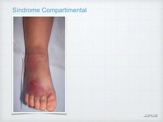 Síndrome Compartimental
Dr. Vejarano A., Willy
Ortopedista y Traumatologo
 
