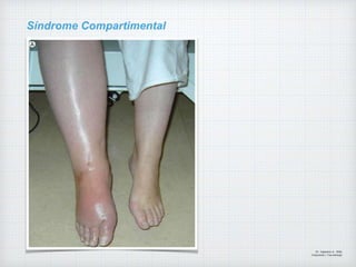 Síndrome Compartimental
Dr. Vejarano A., Willy
Ortopedista y Traumatologo
 