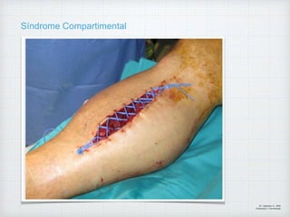 Síndrome Compartimental
Dr. Vejarano A., Willy
Ortopedista y Traumatologo
 