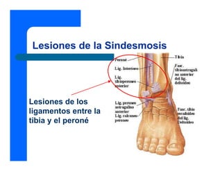 Lesiones de la Sindesmosis
Lesiones de los
ligamentos entre la
tibia y el peroné
 