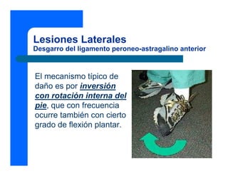 Lesiones Laterales
Desgarro del ligamento peroneo-astragalino anterior
El mecanismo típico de
daño es por inversión
con rotación interna del
pie, que con frecuencia
ocurre también con cierto
grado de flexión plantar.
 