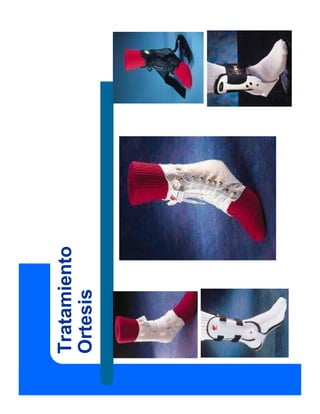 Tratamiento
Ortesis
 
