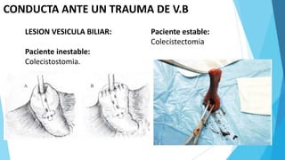 CONDUCTA ANTE UN TRAUMA DE V.B
LESION VESICULA BILIAR:
Paciente inestable:
Colecistostomia.
Paciente estable:
Colecistectomia
 