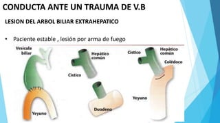 CONDUCTA ANTE UN TRAUMA DE V.B
LESION DEL ARBOL BILIAR EXTRAHEPATICO
• Paciente estable , lesión por arma de fuego
 