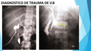 DIAGNOSTICO DE TRAUMA DE V.B
 