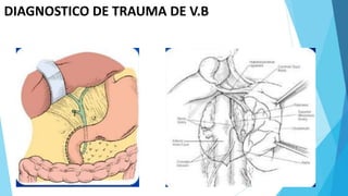 DIAGNOSTICO DE TRAUMA DE V.B
 