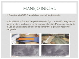 MANEJO INICIAL
• 1. Practicar el ABCDE, estabilizar hemodinámicamente.
• 2. Estabilizar la fractura de pelvis con una faja. La tracción longitudinal
sobre la piel o los huesos es de primera elección. Puede ser mediante
el uso de una sábana con el fin de comprimir la pelvis y reducir el
sangrado.
 