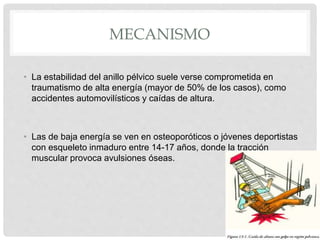 MECANISMO
• La estabilidad del anillo pélvico suele verse comprometida en
traumatismo de alta energía (mayor de 50% de los casos), como
accidentes automovilísticos y caídas de altura.
• Las de baja energía se ven en osteoporóticos o jóvenes deportistas
con esqueleto inmaduro entre 14-17 años, donde la tracción
muscular provoca avulsiones óseas.
 