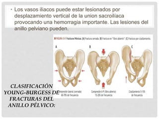 • Los vasos iliacos puede estar lesionados por
desplazamiento vertical de la union sacroilíaca
provocando una hemorragia importante. Las lesiones del
anillo pelviano pueden.
CLASIFICACIÓN
YOUNG-BURGESS DE
FRACTURAS DEL
ANILLO PÉLVICO:
 