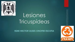 Lesiones
Tricuspídeas
R2MI HECTOR ULISES ONOFRE ESCUTIA
 