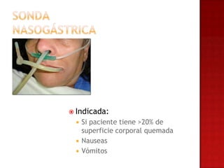  Indicada:
    Si paciente tiene >20% de
     superficie corporal quemada
    Nauseas
    Vómitos
 