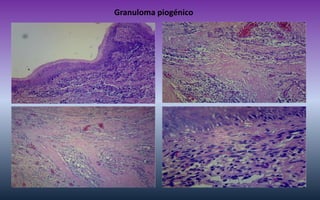 Granuloma piogénico  