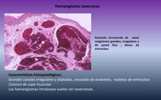 Hemangioma cavernoso 
Características histopatológicas: 
Grandes canales irregulares y dilatados, revestido de endotelio, ...