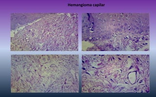 Hemangioma capilar  