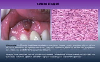 Sarcoma de Kaposi 
Microscopía: Proliferación de células endoteliales en «cardumen de pez» , canales vasculares atípicos, ...