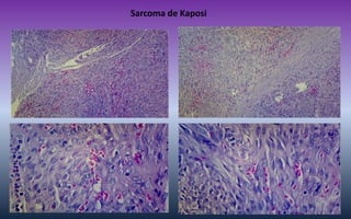 Sarcoma de Kaposi  