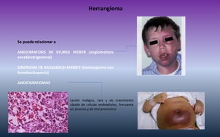 Hemangioma 
Se puede relacionar a ANGIOMATOSIS DE STURGE WEBER (angiomatosis encefalotrigeminal) SINDROME DE KASSABACH-MER...
