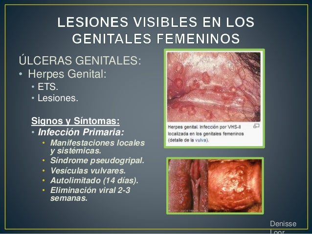 dating site genital warts Let's get the fact straight about genital warts when you have been diagnosed with it dating sites for people living with hpv there are tons of dating websites. dating site genital warts Let's get the fact straight about genital warts when you have been diagnosed with it dating sites for people living with hpv there are tons of dating websites.