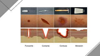 Punzante Cortante Contusa Abrasión
 