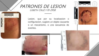 PATRONES DE LESION
Lisbeth Cruz 1-19-2958
Lesion, que por su localizacion o
configuracion, sugiere un objeto causante
o un mecanismo, o una secuencia de
eventos.
 