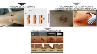 PROYECTIL DE ARMA DE FUEGO
HERIDA POR ARMA CORTOPUNZANTE
EXCORIACIONES POR ELEMENTO CORTO
CONTUNDENTE O COMPATIBLE CON MORDEDURA.
 