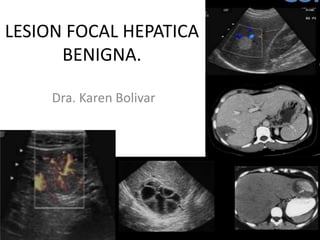 LESION FOCAL HEPATICA
BENIGNA.
Dra. Karen Bolivar

 