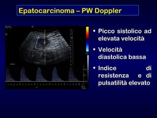 Lesioni focali epatiche (Italian) Slide 48