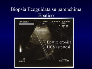 Lesioni focali epatiche (Italian) Slide 75