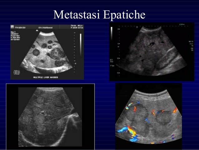 Lesioni Focali Epatiche Italian