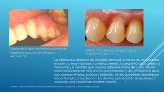 Paciente joven con antecedentes de
cepillado abusivo en tiempo y
frecuencia.
LCNC más ancha que profunda y
con forma de cuña.
La clínica que aparece en la región cervical, a causa de un cepillado
excesivo o muy vigoroso, comienza siendo un pequeño surco o ranura
horizontal y a medida que avanza adquiere forma de cuña, siendo
característicamente más ancha que profunda y de consistencia dura,
con paredes limpias, pulidas y brillantes, en las que jamás deberíamos
encontrar placa bacteriana. La dentina abrasionada se esclerosa y
adquiere una coloración amarillo-marrón.
Álvarez C, Grille C. Revisión de la literatura: lesiones cervicales no cariogénicas. Cient Dent 2008;5;3:215-224.
 