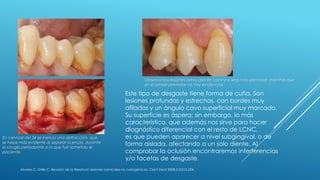 Álvarez C, Grille C. Revisión de la literatura: lesiones cervicales no cariogénicas. Cient Dent 2008;5;3:215-224.
Observamos lesiones cervicales en canino y segundo premolar; mientras que
en el primer premolar no hay evidencias.
En cervical del 34 se insinúa una abfracción, que
se hace más evidente al separar la encía, durante
la cirugía periodontal a la que fue sometido el
paciente.
Este tipo de desgaste tiene forma de cuña. Son
lesiones profundas y estrechas, con bordes muy
afilados y un ángulo cavo superficial muy marcado.
Su superficie es áspera; sin embargo, lo más
característico, que además nos sirve para hacer
diagnóstico diferencial con el resto de LCNC,
es que pueden aparecer a nivel subgingival, o de
forma aislada, afectando a un solo diente. Al
comprobar la oclusión encontraremos interferencias
y/o facetas de desgaste.
 