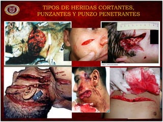 TIPOS DE HERIDAS CORTANTES,
PUNZANTES Y PUNZO PENETRANTES
 