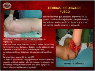 HERIDAS POR ARMA DE
FUEGO
Son las lesiones que ocasiona el proyectil a su
paso a través de los tejidos del cuerpo humano.
Las lesiones varían según la distancia y la zona
del cuerpo donde penetra el proyectil.
SEGÚN LA ZONA DEL CUERPO DONDE PENETRA EL
PROYECTIL.
1-Heridas sobre zonas blandas, donde la piel es depresible y
no tiene elementos óseos por debajo: muslo, abdomen, etc.
2.-Heridas sobre zonas duras, donde la piel tiene,
inmediatamente por debajo un plano óseo: cráneo, tórax,
etc.
Características a describir en las HAF.
Las heridas por arma de fuego presentan: lesión de entrada,
trayecto, lesión de salida y además, lesiones producidas por
elementos acompañantes que en ocasiones agregan su
efecto a los producidos por el proyectil.
PROYECTIL EXPLOSIVO
 