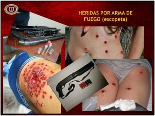 HERIDAS POR ARMA DE
FUEGO (escopeta)
 