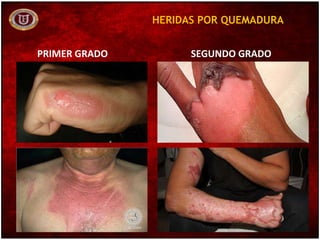 HERIDAS POR QUEMADURA
PRIMER GRADO SEGUNDO GRADO
 