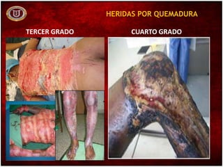 HERIDAS POR QUEMADURA
TERCER GRADO CUARTO GRADO
 