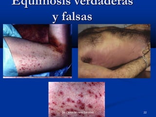 Dra. Marlene Mendoza Navarro
Equimosis verdaderas
y falsas
Dr. Carlos Moreno Sánchez 22
 