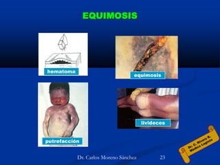 EQUIMOSIS
equimosis
livideces
putrefacción
hematoma
Dr. Carlos Moreno Sánchez 23
 