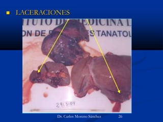  LACERACIONES
Dr. Carlos Moreno Sánchez 26
 